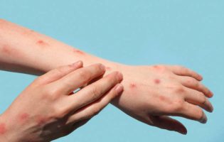 Monkeypox new disease dangerous over the world. Patient with Monkey Pox. Painful rash, red spots blisters on the hand. Close up rash, human hands with Health problem. Banner, copy space. Painful rash, red spots blisters on the hand. Close up Allergy rash, human hands with dermatitis and Health problem. Ill eczema skin of patient. Viral Diseases. Red rashes on the palm. Enterovirus. coxsackie